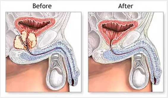 Robotic Prostatectomy Surgery - Before and After