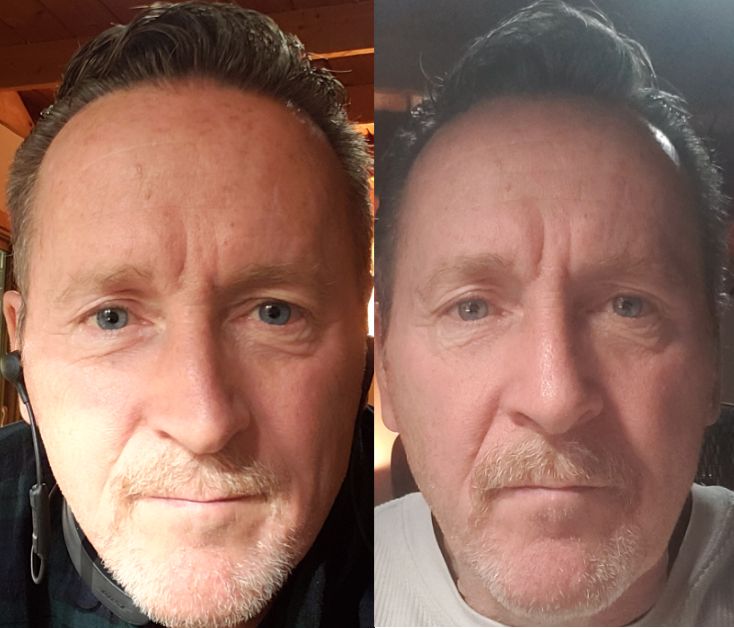 septoplasty before and after